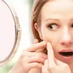 Acne-remedies-for-PCOS