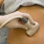 Diagnosis Of Ovarian Cysts