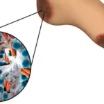 diabetic foot ulcers